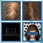 women and hair loss