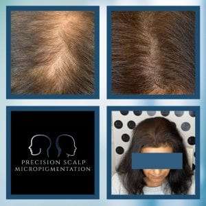 women and hair loss