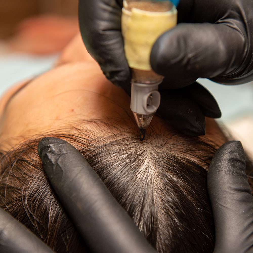 hair loss in women