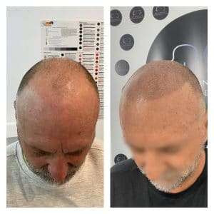 Hairlosss Treatment