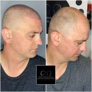 Hairloss Treatment