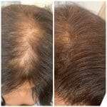 hair thinning