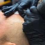 SMP VS HAIR TRANSPLANT